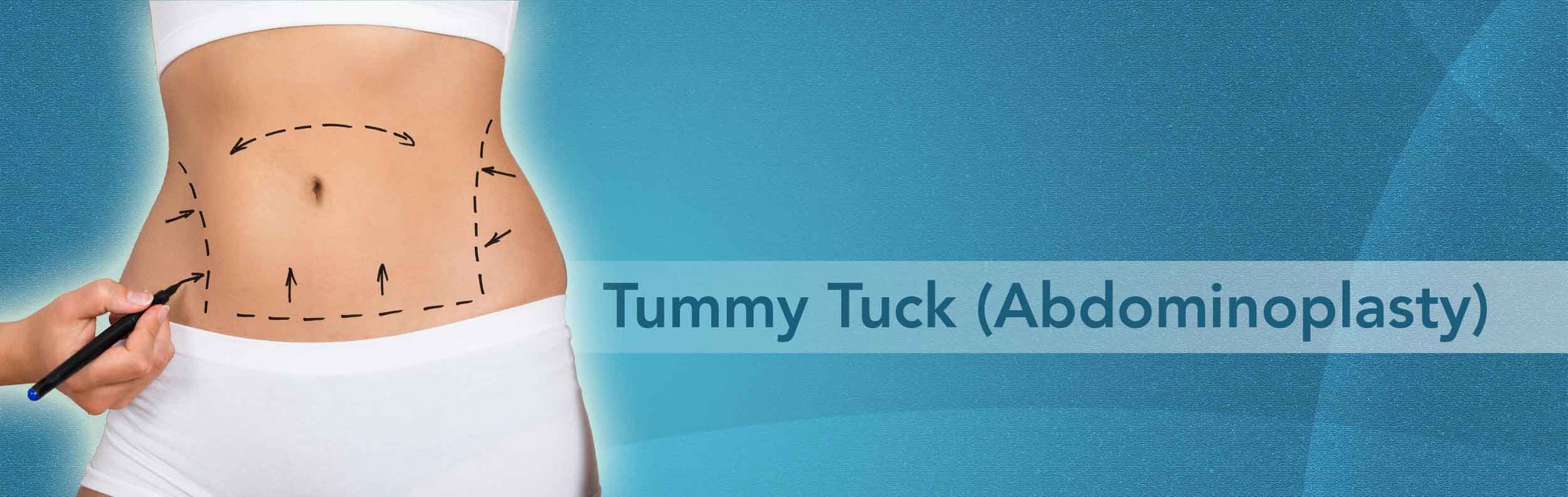 bukplastik-tummy-tuck