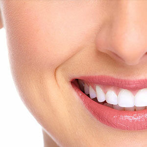 dental veneers