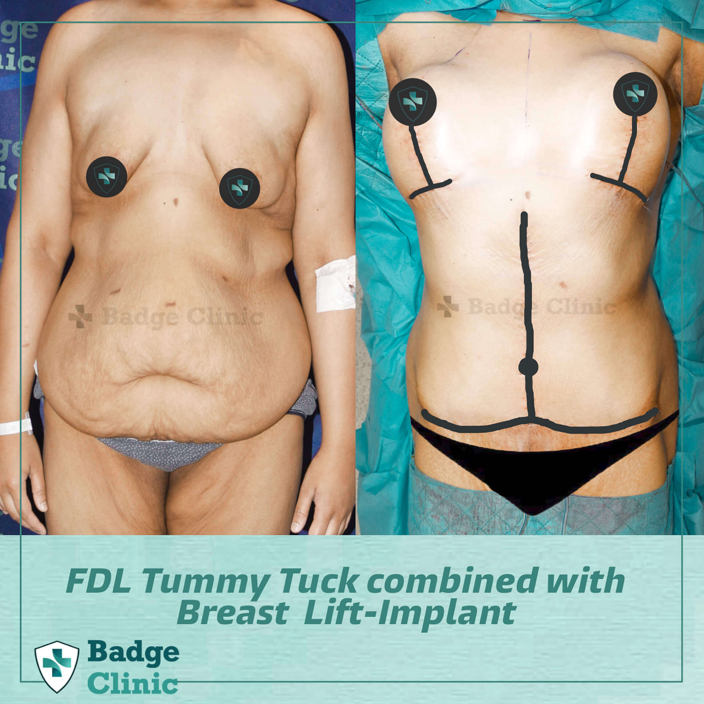 Tummy Tuck (Abdominoplasty)  Dr. Lamblet Plastic Surgery