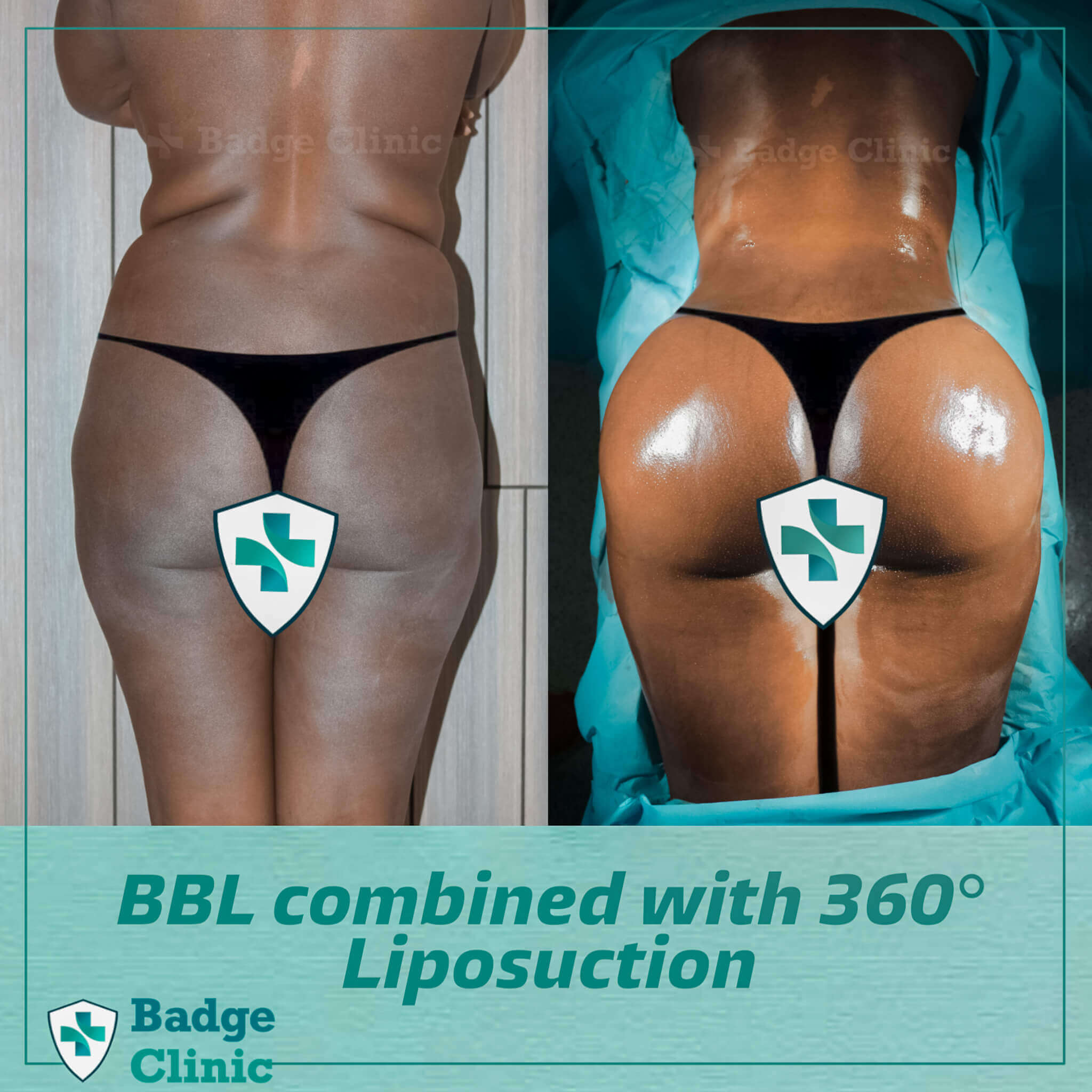 Plastic&Cosmetic Surgery, Who said a #BBL has to look “fake” it's a new  age of #bbls 🍑#conservative #frenchbuttreshaping #FBR #premiercosmeticla  #DrYu #BB