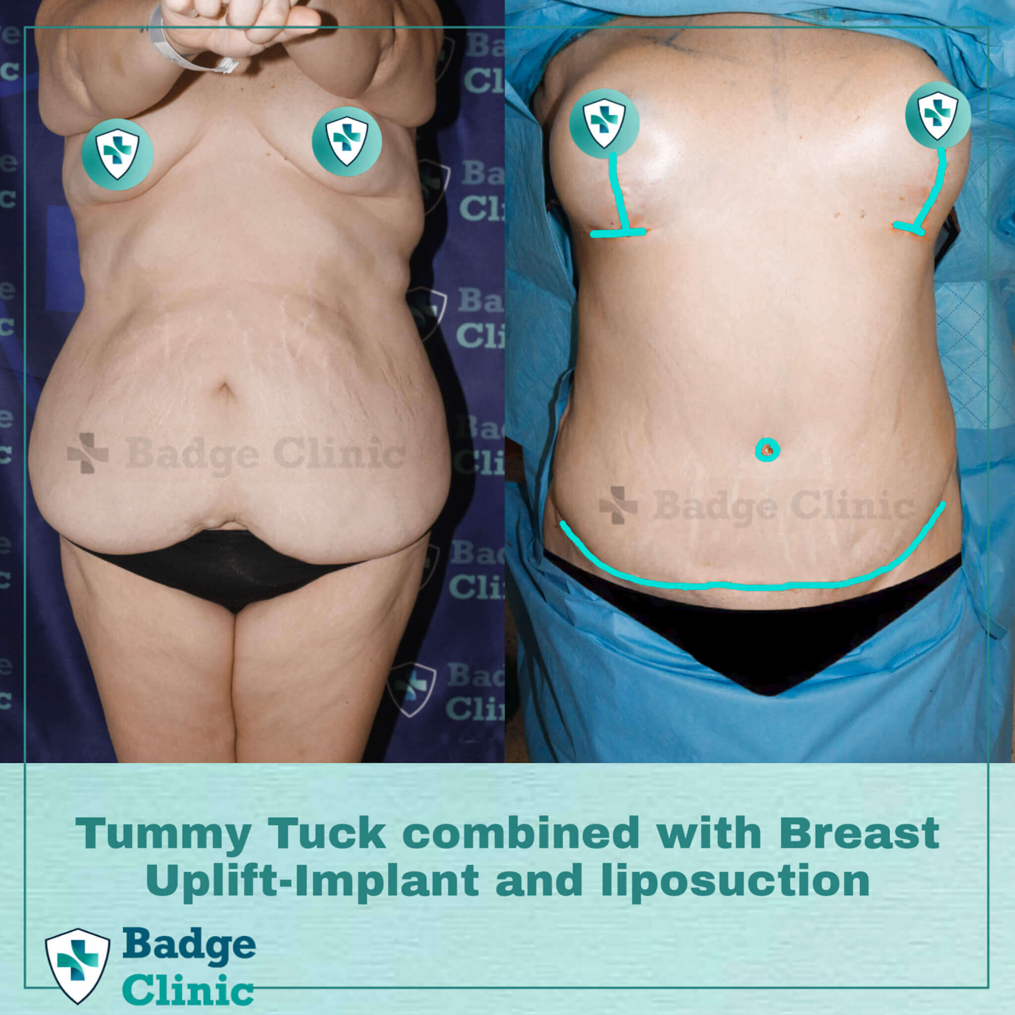 Tummy Tuck Turkey - Clinicpark