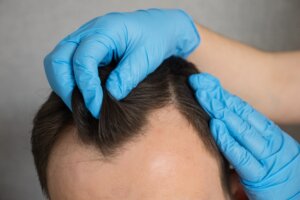 treating male pattern baldness